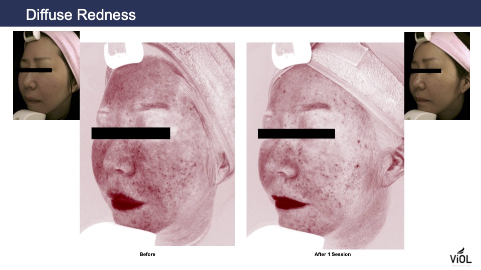 diffuse redness 1