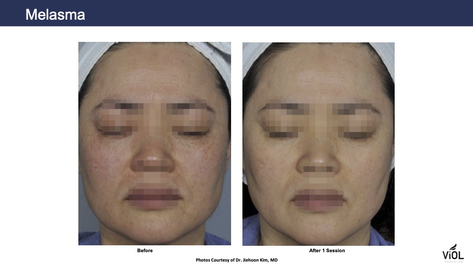 melasma 2