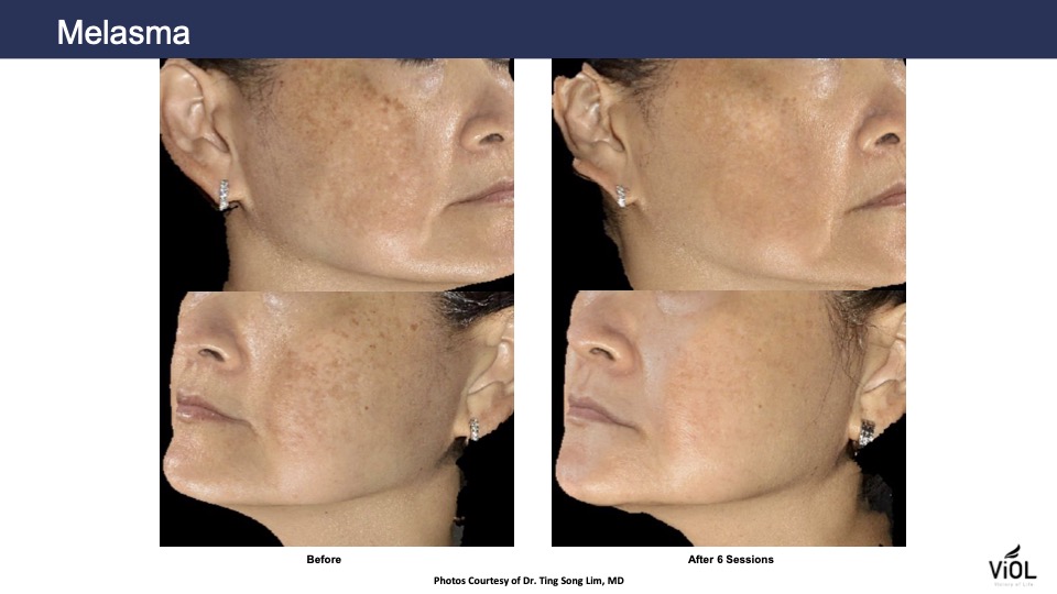 melasma 3