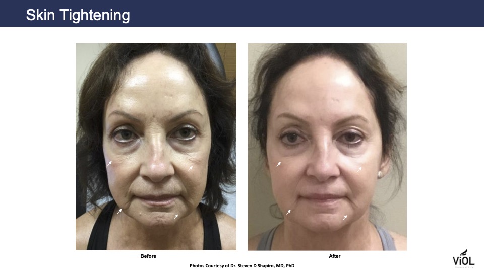 skin tightening 1