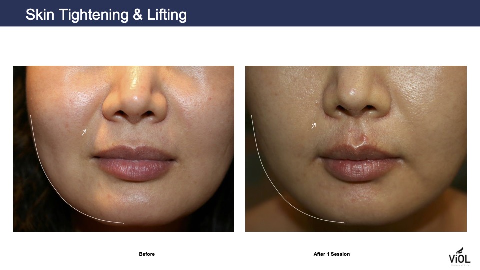 skin tightening 2
